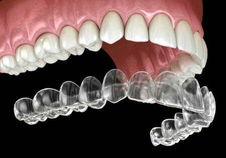Aligners
