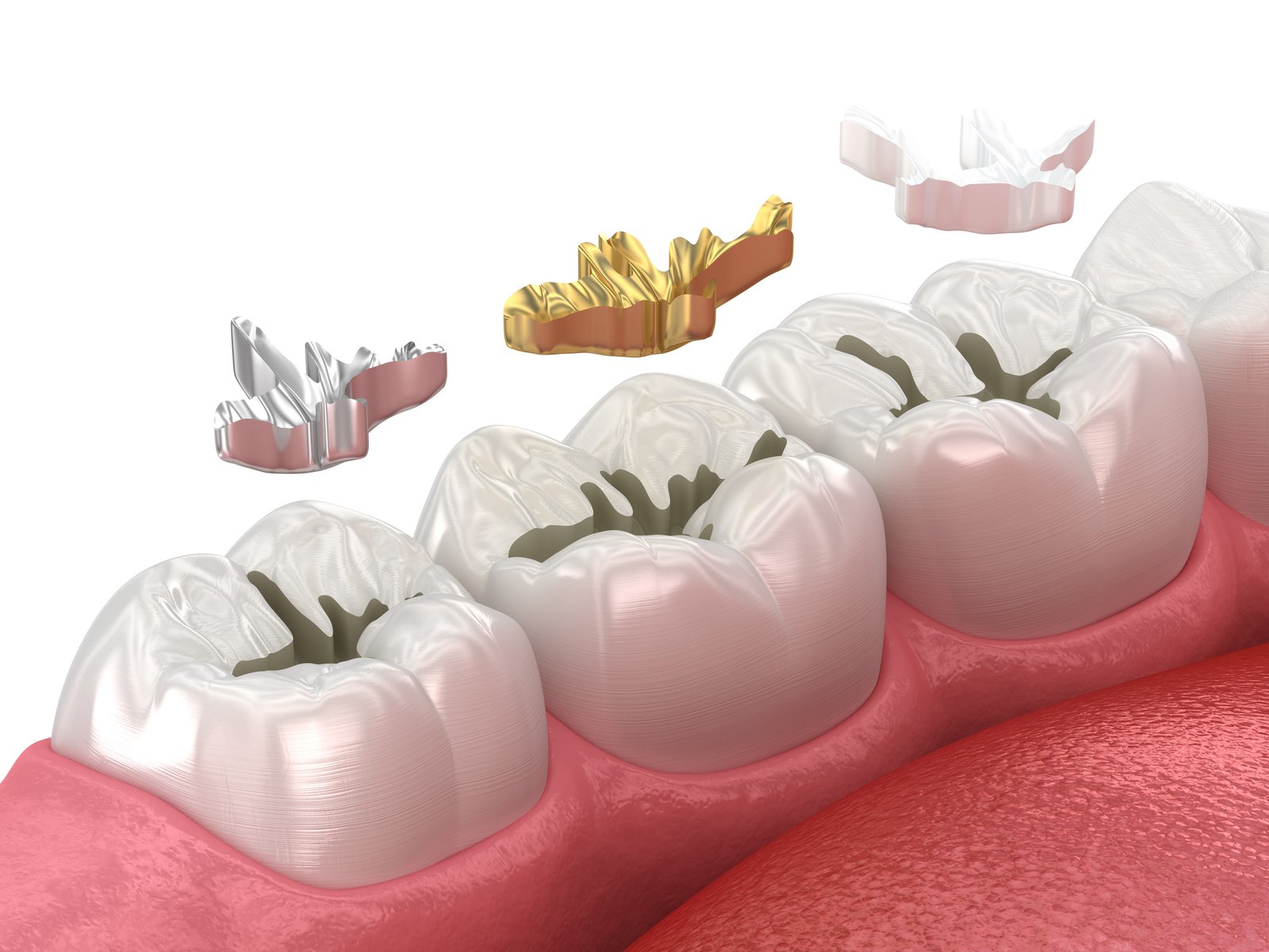 Dental fillings: ceramic, golden, metal. Dental 3D illustration