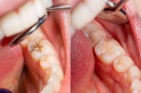 Tooth filling